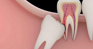 Tổng hợp 5 thông tin cần biết về Răng khôn