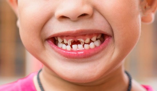 4 bệnh lý về răng miệng mà trẻ nhỏ thường gặp