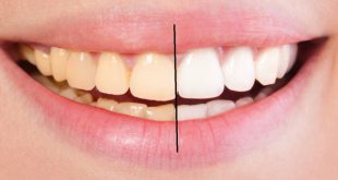 Sự liên quan giữa màu sắc của răng và sức khỏe răng miệng