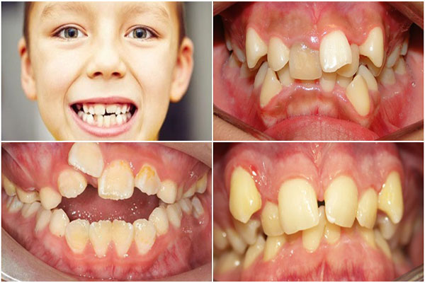 Răng trẻ mọc lệch lạc là do đâu?