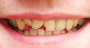 Tổng hợp các dạng chấn thương răng thường gặp nhất
