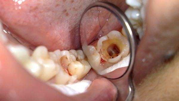 Răng bị viêm tủy