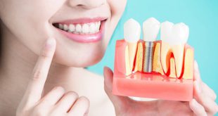Những việc cần làm để chăm sóc răng sau cấy ghép implant