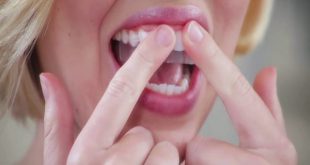 Sử dụng miếng dán tẩy trắng tại nhà coi chừng hỏng răng
