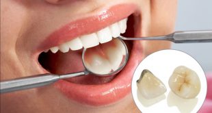 Những ưu nhược điểm của phương pháp trồng răng sứ
