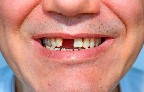 3 bệnh lý răng miệng gây mất răng phổ biến