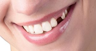Cảnh báo nguy cơ mất răng do 3 bệnh răng miệng thường gặp