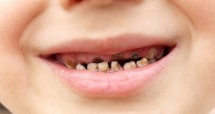 Những trường hợp có nguy cơ cao mắc bệnh sâu răng?