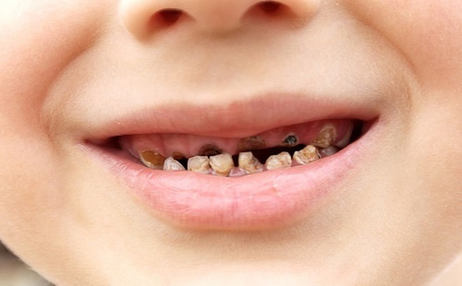Sún răng ở trẻ nhỏ là do đâu?