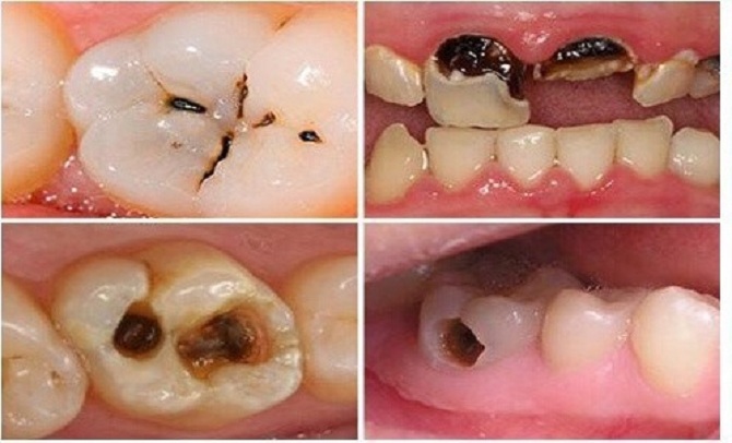 Hiểu hơn về bệnh sâu răng