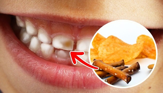 Những loại thực phẩm gây hại cho răng