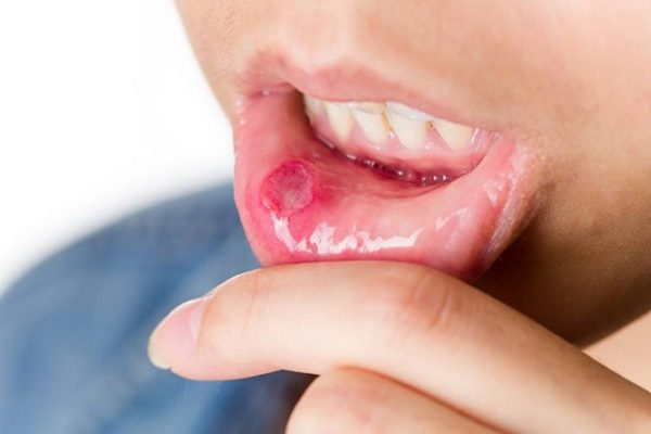 Bệnh răng miệng và sự liên quan tới sức khỏe tổng thể
