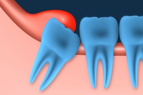 Thông tin và cách xử lý khi răng khôn Lợi Trùm