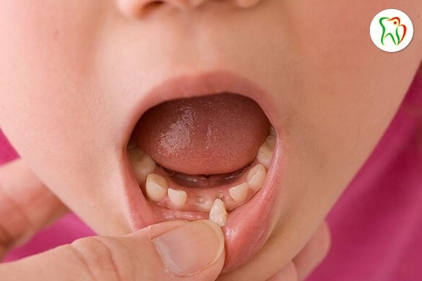 Vì sao trẻ thay răng chậm?
