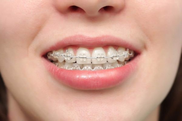 Niềng răng giúp khắc phục tình trạng khớp cắn đối đầu