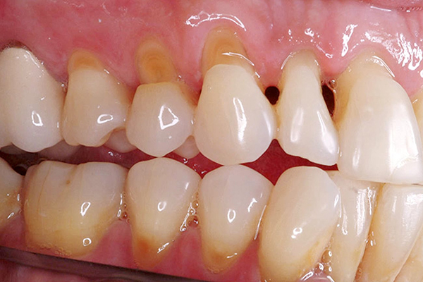 Tìm hiểu về hiện tượng tụt lợi chân răng và cách điều trị