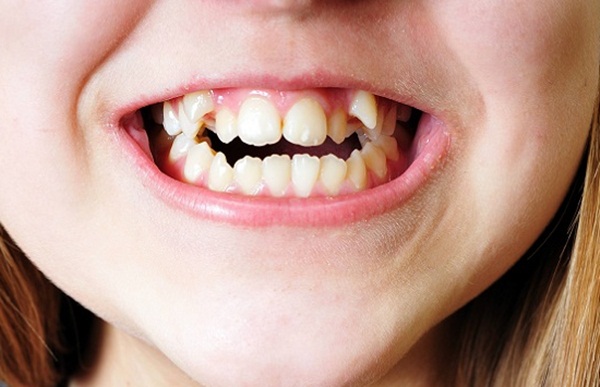 Tìm hiểu về tình trạng răng nanh mọc ngầm và cách điều trị
