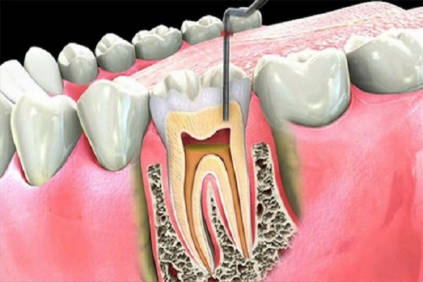 Cùng chuyên gia phục hình răng tìm hiểu quá trình điều trị viêm tủy răng