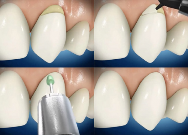 Phục hồi cổ răng bằng Composite