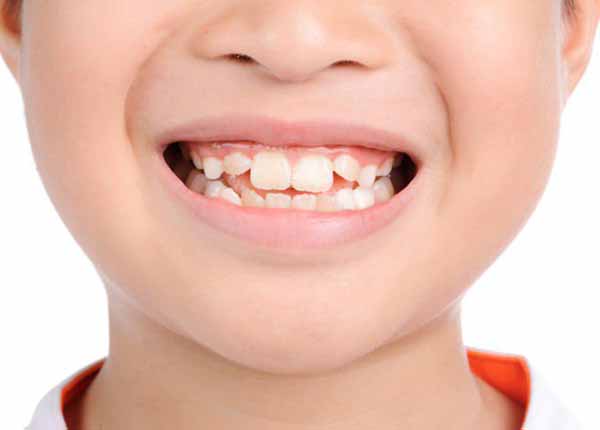 Nguyên nhân và dấu hiệu của trẻ mọc răng lệch