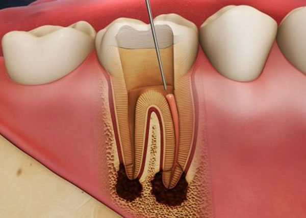 Viêm tủy răng khiến bạn vô cùng khó chịu khi ăn uống
