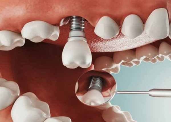 Răng giả implant này gồm 3 bộ phận