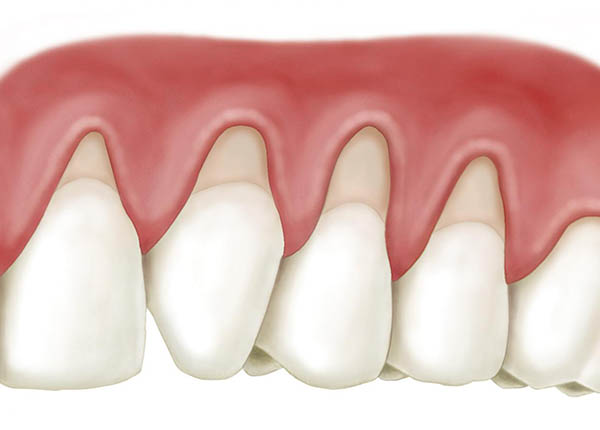 Tụt nướu làm lộ chân răng khiến răng như dài hơn, dễ bị bám thức ăn và làm hỏng răng