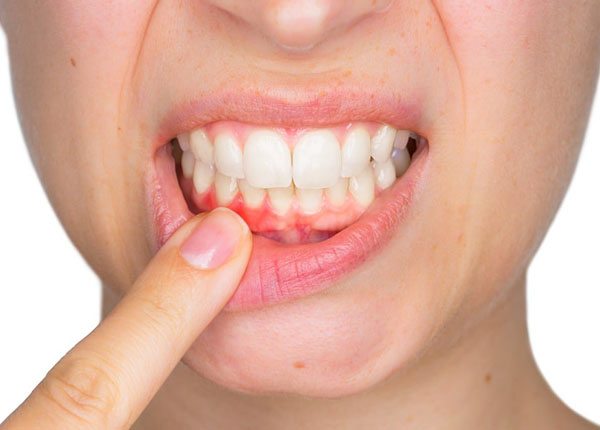 Viêm nha chu hay còn gọi là viêm lợi đây là một bệnh lý nhiễm khuẩn của các tổ chức xung quanh răng