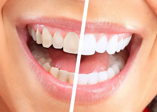 Tẩy trắng răng là phương pháp giúp răng trắng sáng vô cùng hiệu quả
