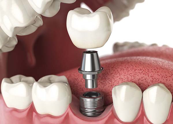 Răng Implant tương tự như một chiếc răng thật