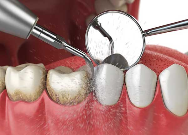 Cao răng là các mảng bám tích tụ lâu ngày trên bề mặt răng