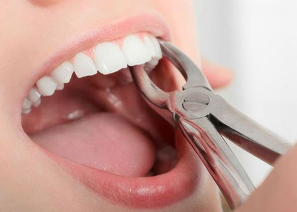 Nhổ răng vĩnh viễn có ảnh hưởng gì và cần lưu ý điều gì?